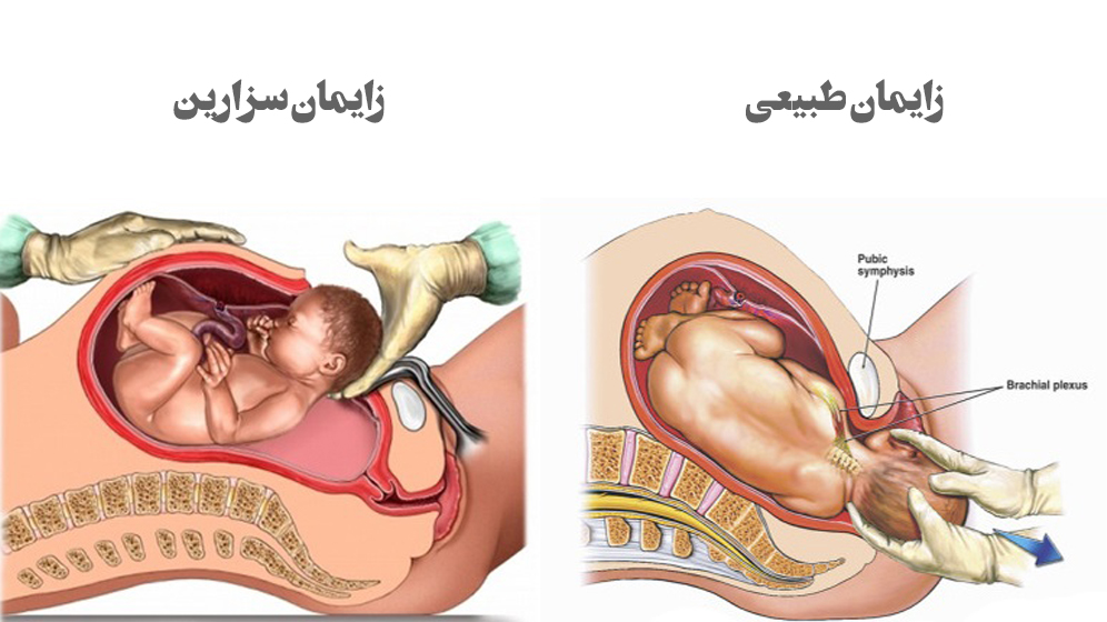 مقایسه زایمان طبیعی و سزارین