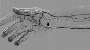 آنژیوگرافی دست