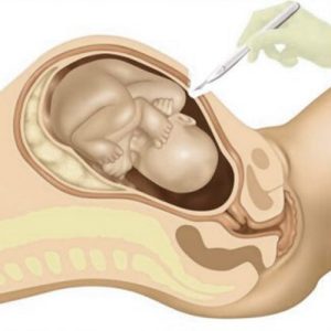 برش و دسترسی به رحم برای زایمان سزارین