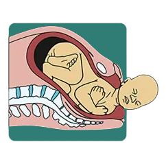 استراحت و تغییر وضعیت دوباره نوزاد (Restitution (External Rotation))