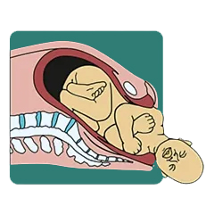 خروج شانه قدامی نوزاد (Delivery of Anterior Shoulder)