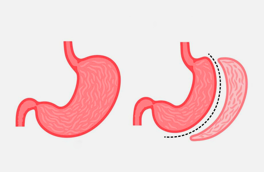 تصویری از عمل اسلیو معده