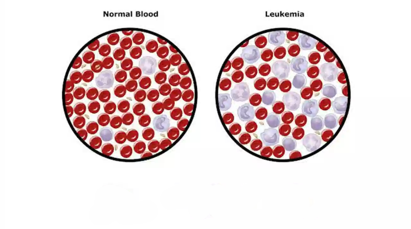 تصویری از سرطان خون