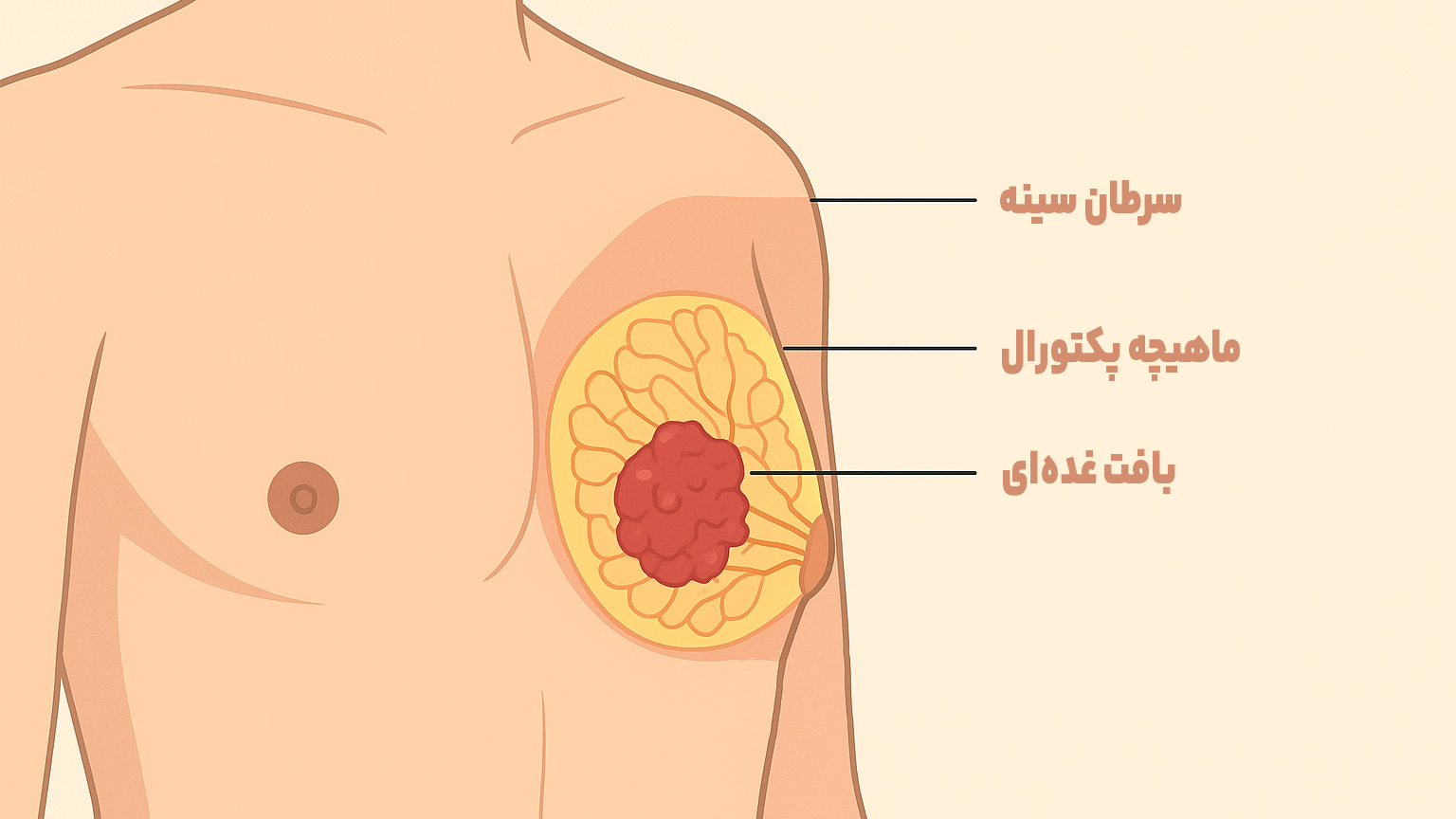 سرطان سینه در مردان