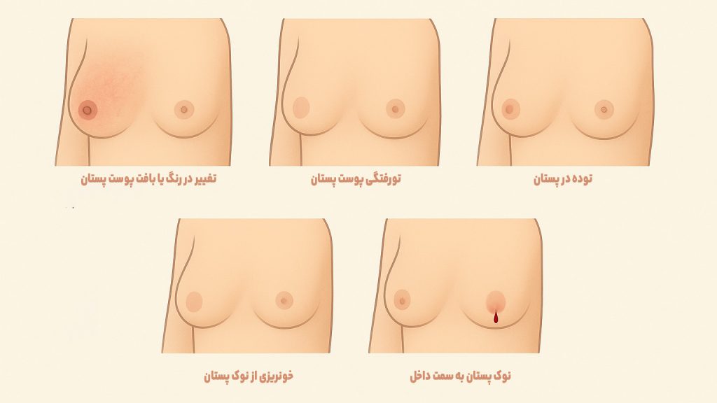 علائم و نشانههای سرطان سینه