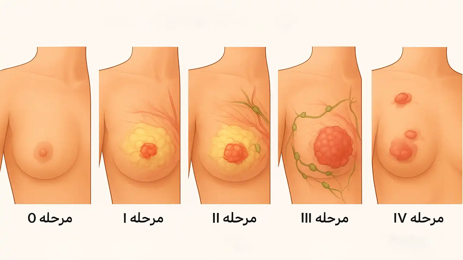 درجه‌بندی شدت سرطان سینه