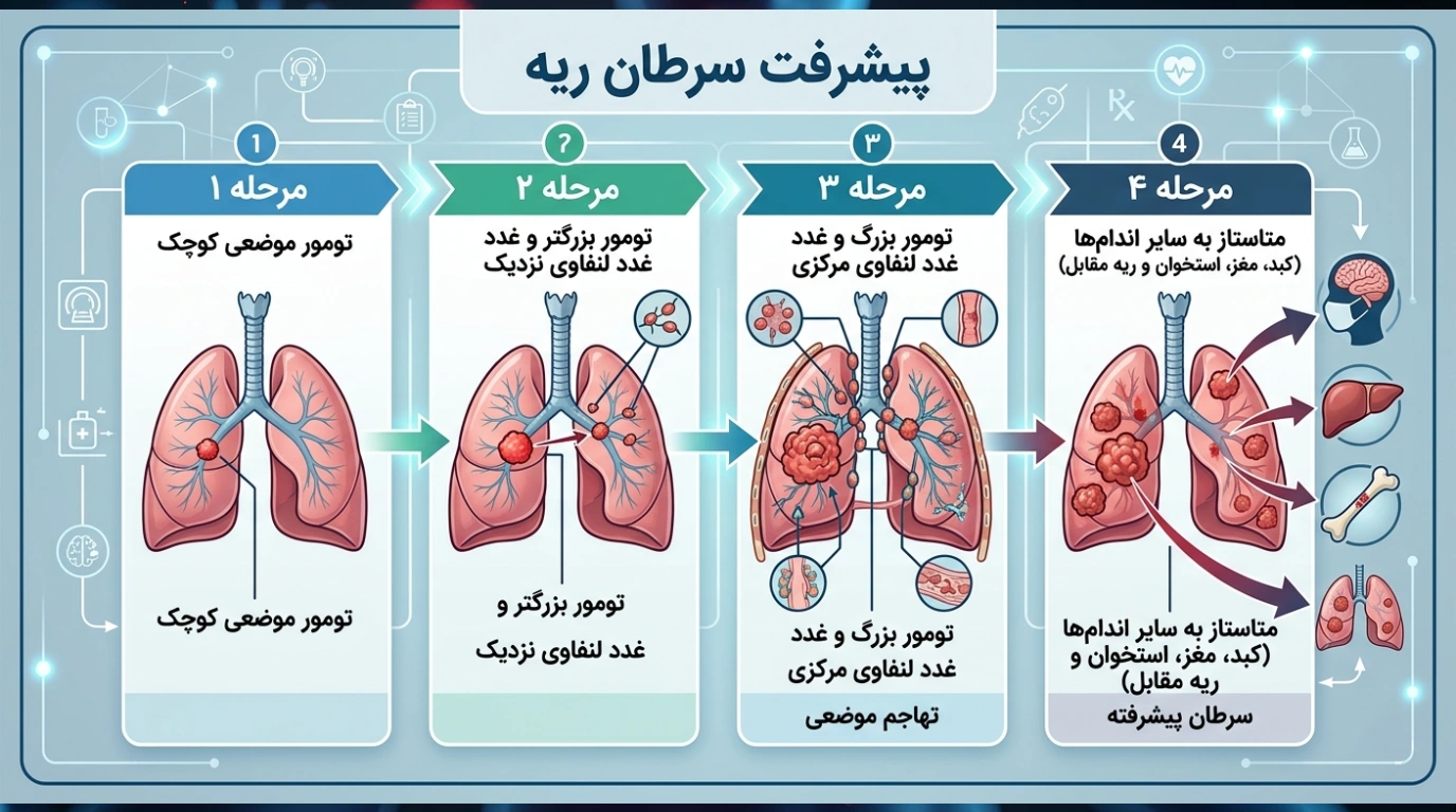 در هر مرحله از سرطان ریه چه اتفاقی میافتد؟