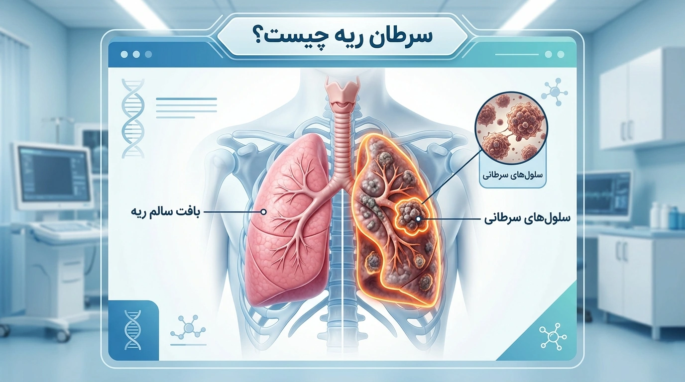 سرطان ریه چیست؟