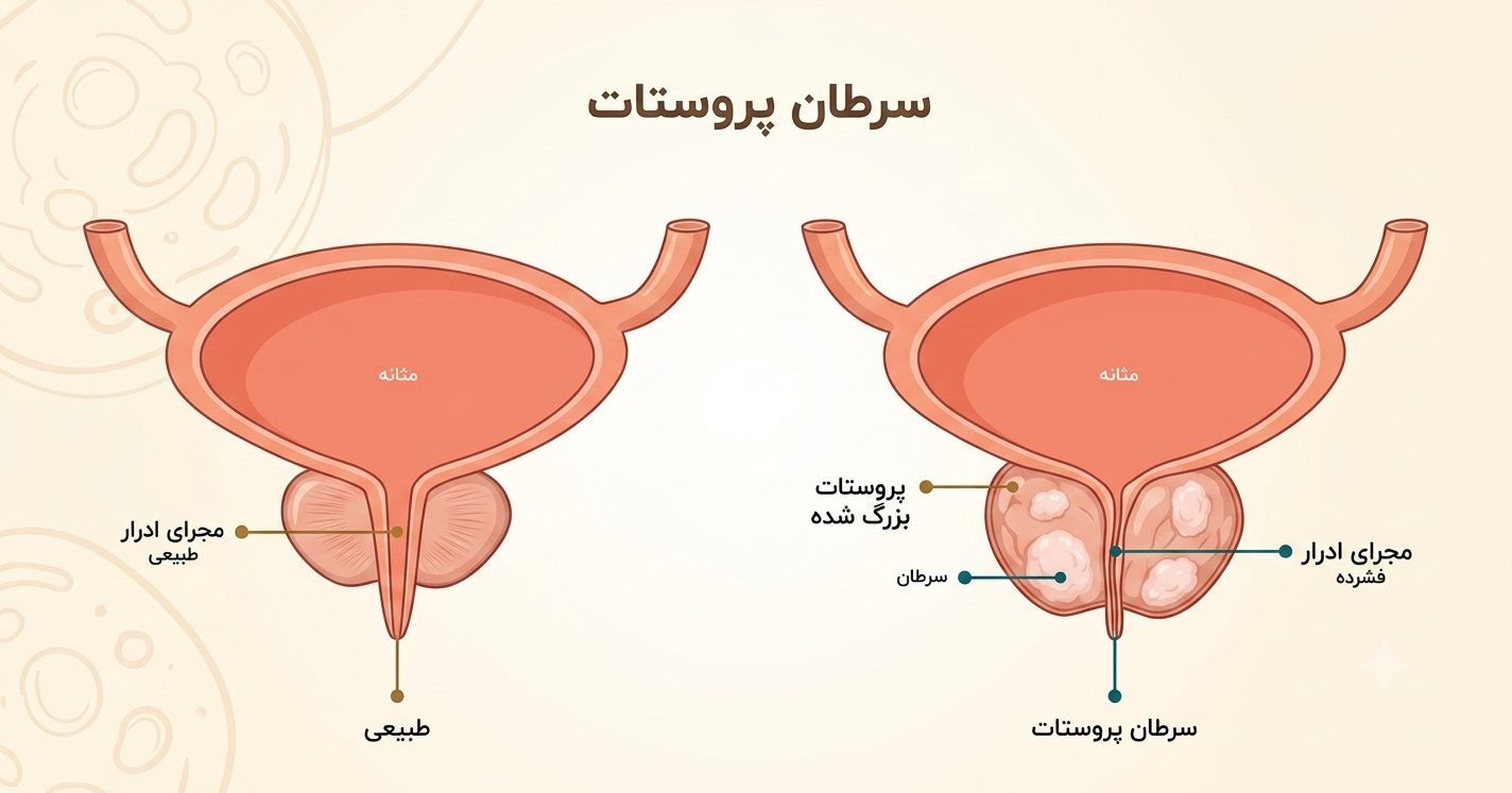تفاوت پروستات سالم و سرطانی
