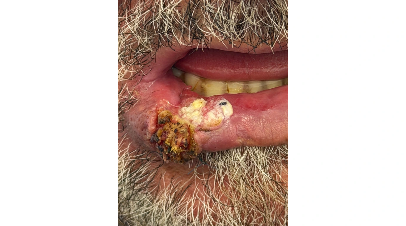 سرطان سلول سنگفرشی (Carcinoma سلول سنگفرشی)