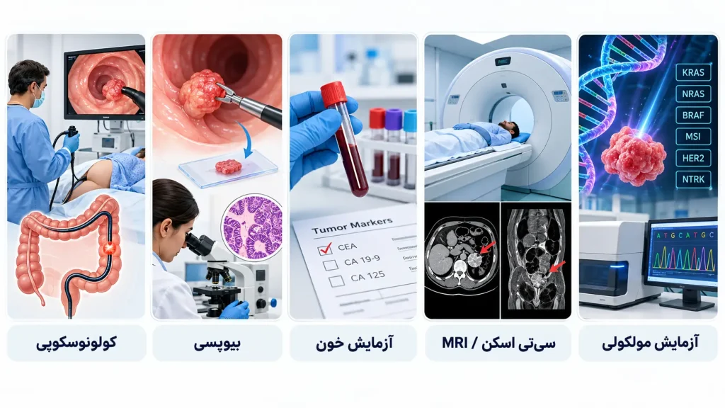 تشخیص سرطان روده بزرگ