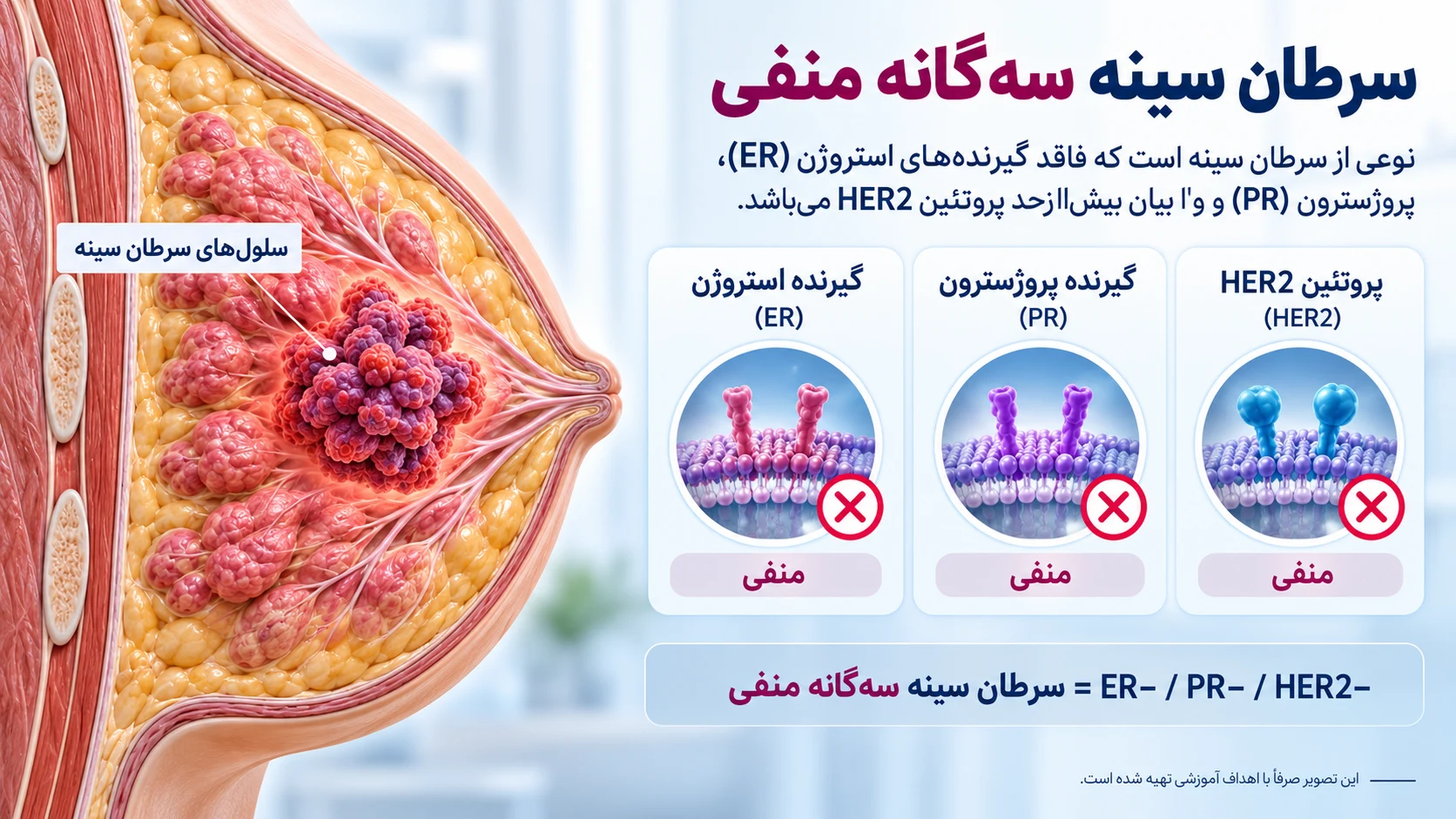 انواع سرطان سینه سه گانه