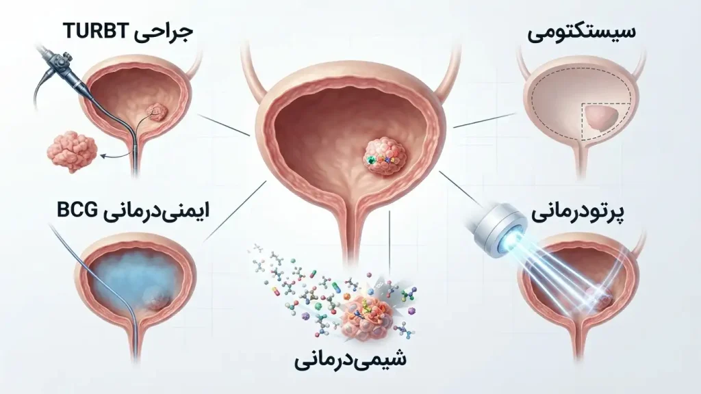 روش‌های موثر در درمان سرطان مثانه